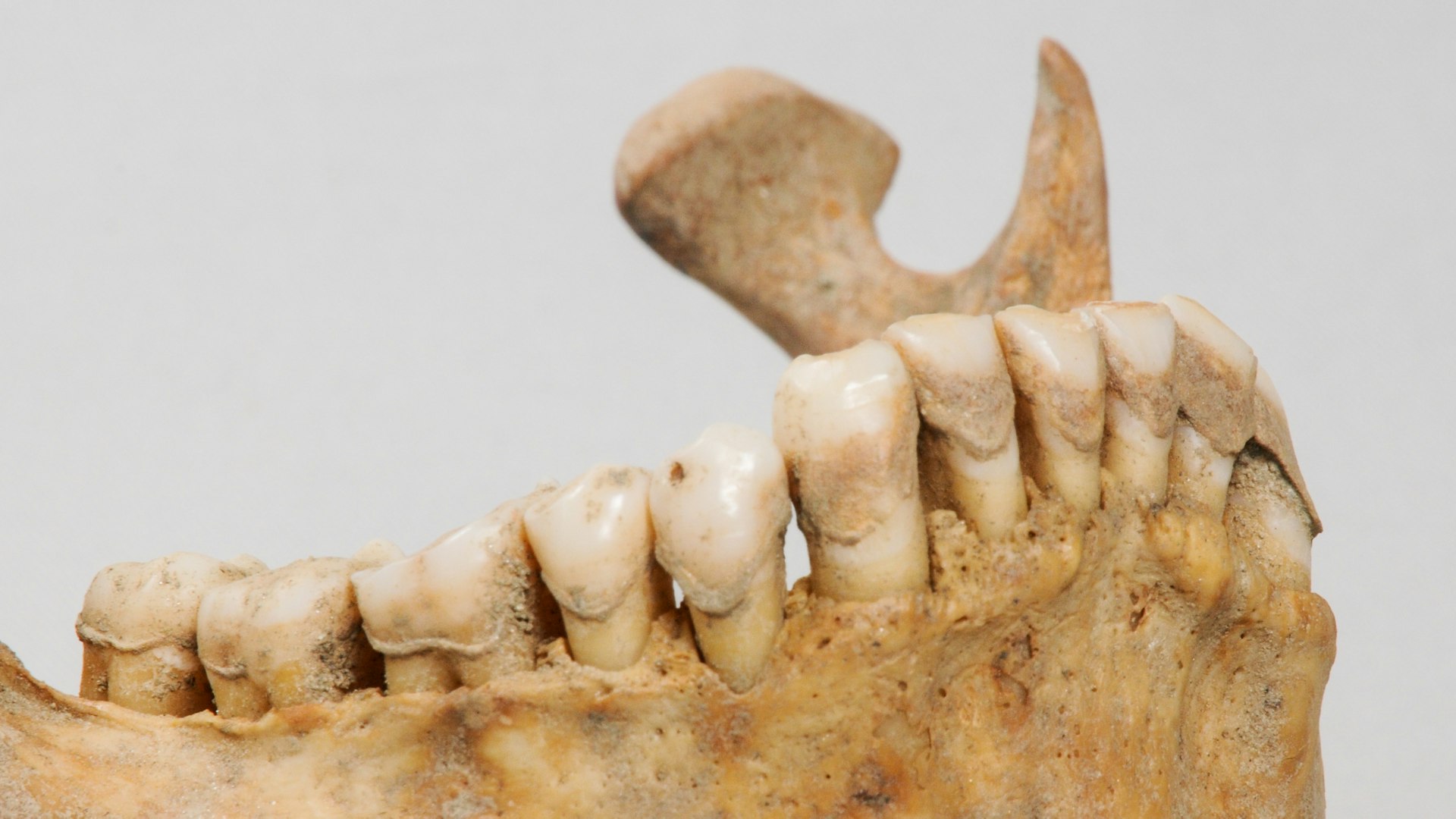 Questa immagine mostra la placca dentale di uno scheletro risalente all’Alto Medioevo