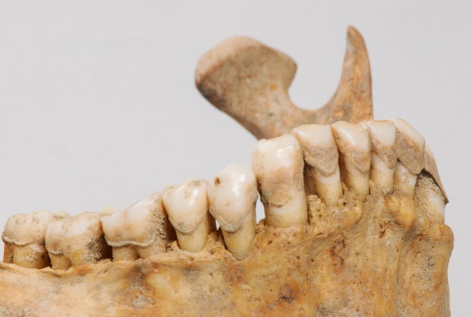 Dieses Bild zeigt den Zahnstein eines untersuchten Individuums aus dem Frühmittelalter