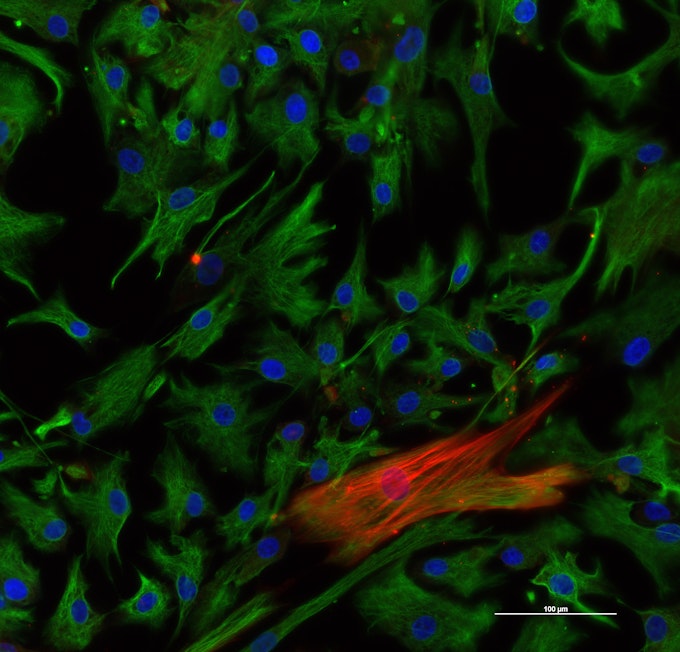 Ein hinzugefügter roter Marker kennzeichnet aktive Fibroblasten, die Narbengewebe bilden. Die große Zelle, die grün und rot gefärbt ist, ist ein aktiver Fibroblast, während alle anderen grünen Zellen Fibroblasten sind, die nicht aktiv sind. (Die blauen Punkte sind die Zellkerne.)